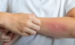 Egzama yalnızca cildi değil, sosyal yaşamı da etkileyebiliyor