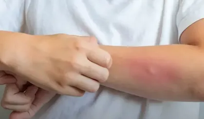 Egzama yalnızca cildi değil, sosyal yaşamı da etkileyebiliyor